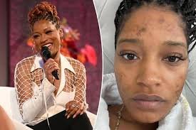 temp_image_1779456348.359984 Keke Palmer Opens Up About Her Battle With Adult Acne and PCOS Diagnosis