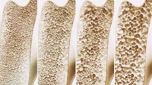 temp_image_1781597058.993334 Rethinking Bone Health: Do Calcium and Vitamin D Supplements Really Prevent Falls and Fractures?